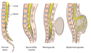 Neural-tube-defects